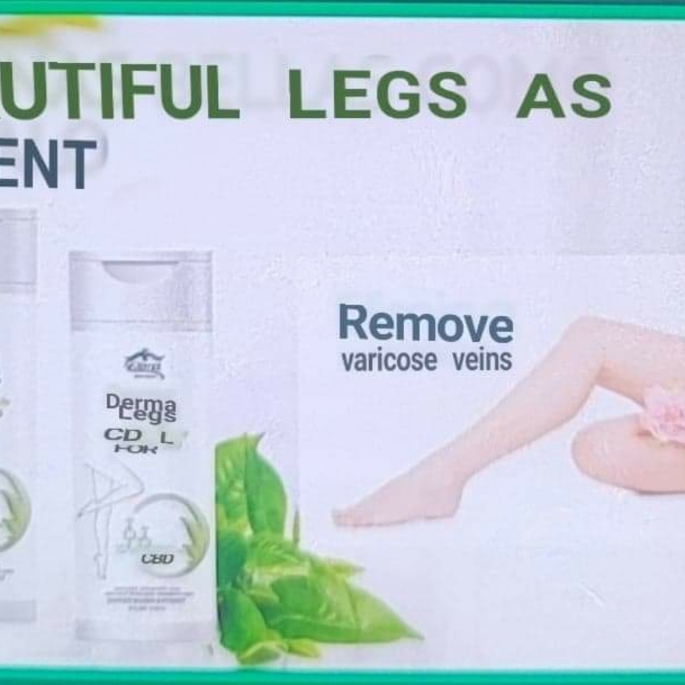 Varicose Veins